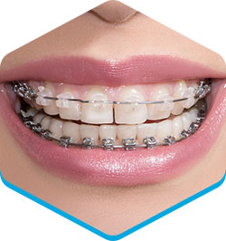 braces-clear-braces