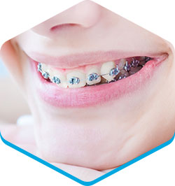 braces-metal-braces