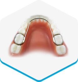 appliances-lingual-arch