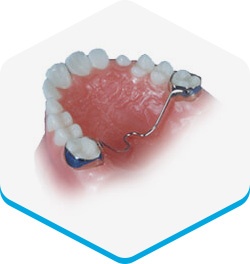 appliances-transpalatal-arch