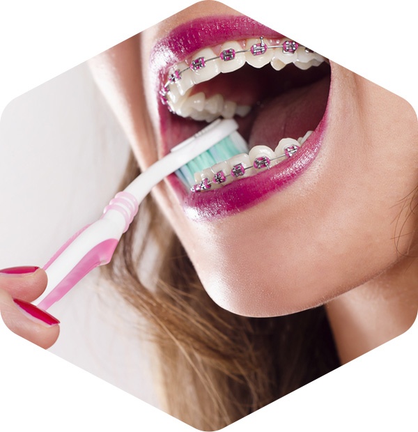 How to brush and floss with metal braces