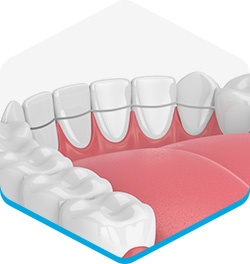 Houston Orthodontist Specialists provides fixed retainers as a dental treatment appliance