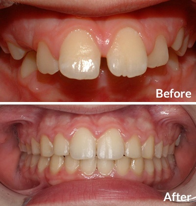 Before and after images of a child who had an overbite