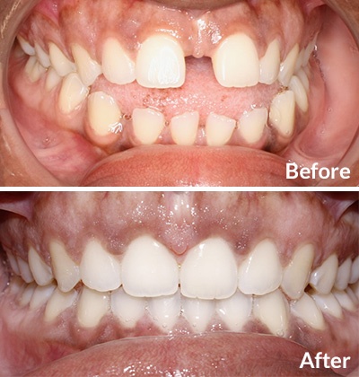 Before and after images of an adult with openbite who used invisalign as treatment