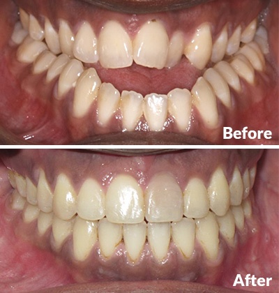 Before and after of dental surgery performed by Houston Orthodontist Specialists