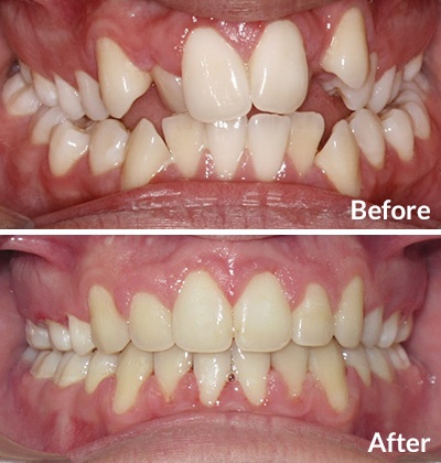 Teen Braces treatment for crowding and overbite, Before and After