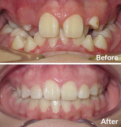 Child Braces treatment for crowding - Before and After