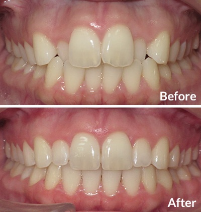Adult Invisalign treatment for crowding and overbite - Before and After