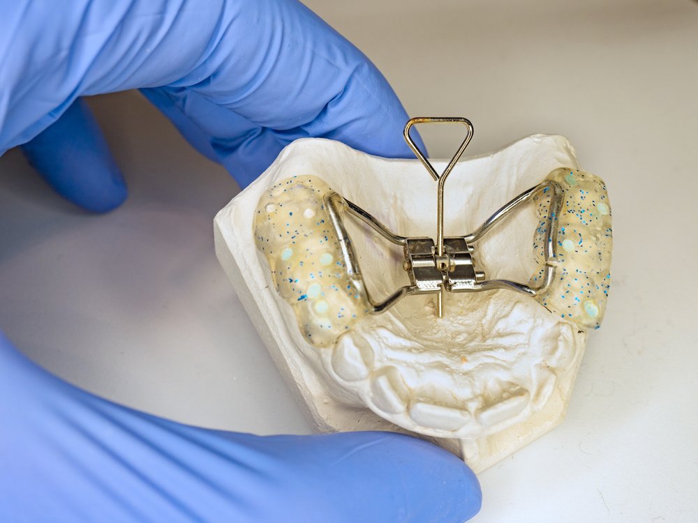 Why use a palatal expander in orthodontics? - Bauer Smiles