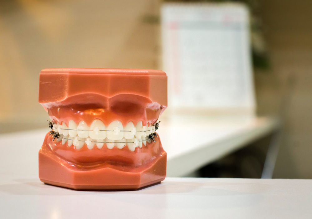 damon clear braces