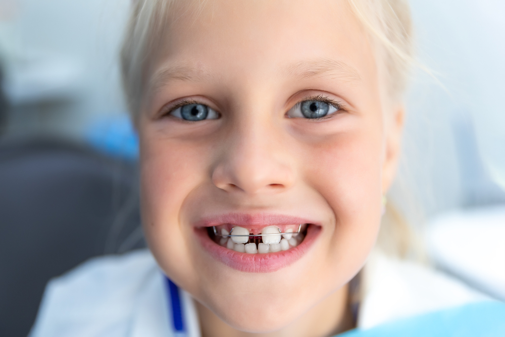 Can You Get Braces With Missing Teeth?