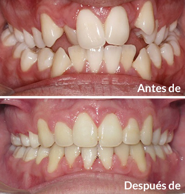 before after