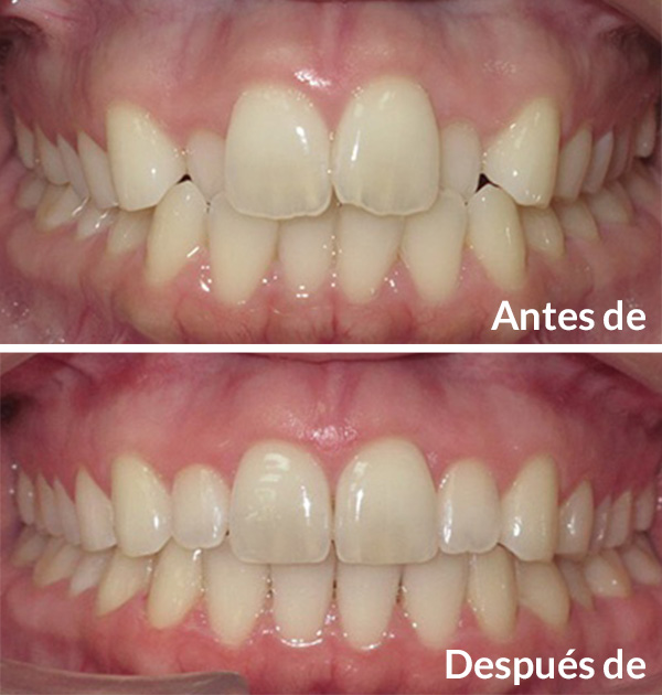 before after